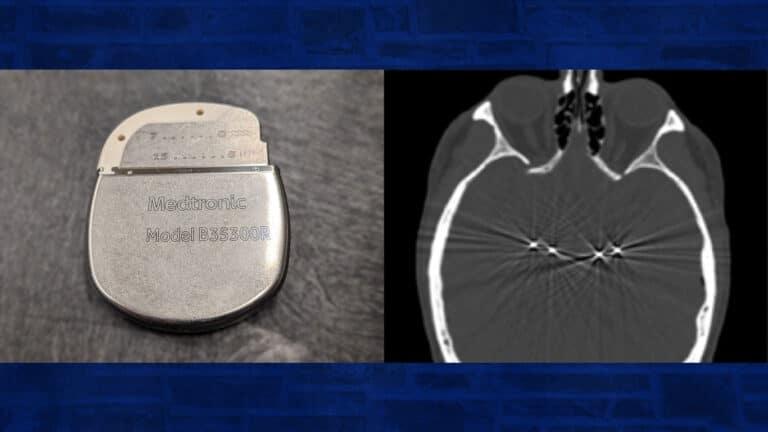 Deep Brain stimulator and visualization of it working in a brain